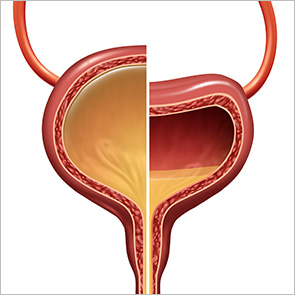 Split image of a normal and neurogenic bladder