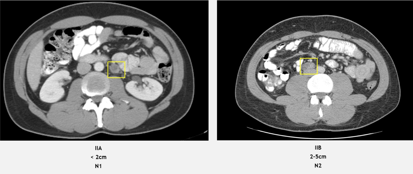 stage II disease