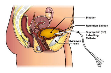 Suprapubic Catheter