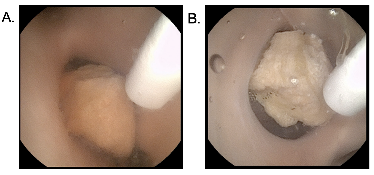 thulium_laser_lithotripsy_AUA22.png