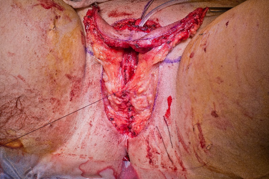 urethral_suture_line.png