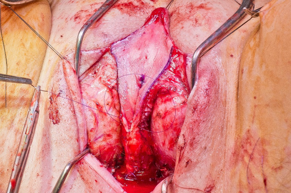 ventral_closure.png